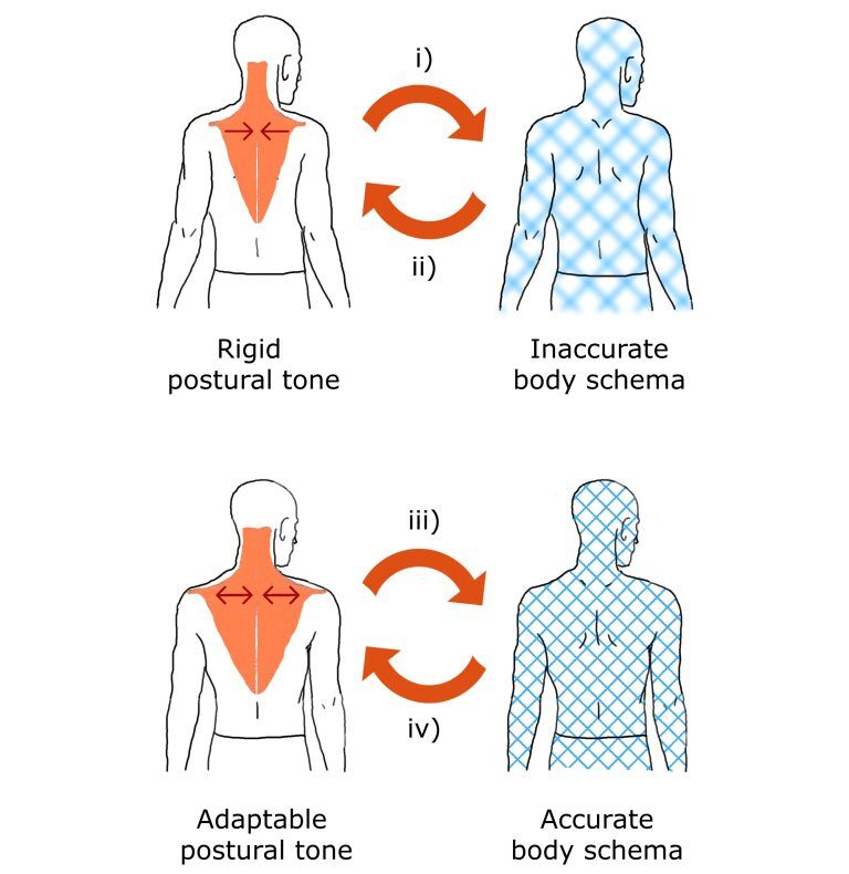 Postural Incisional Why your map matters: body schema and postural tone | Bristol Alexander ...